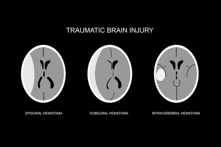 illustration-of-common-imaging-following-traumatic-brain-injury-gm1502897707-522880443